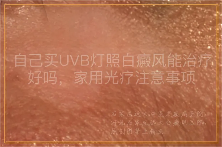 自己买UVB灯照白癜风能治疗好吗，家用光疗注意事项