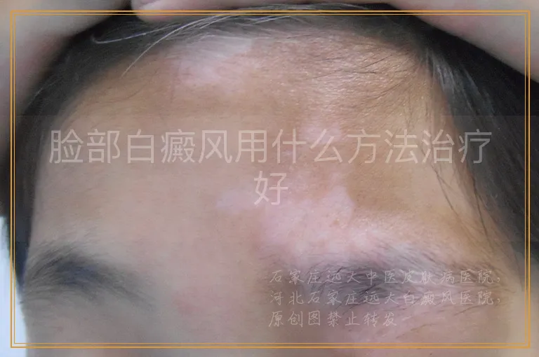 脸部白癜风用什么方法治疗好