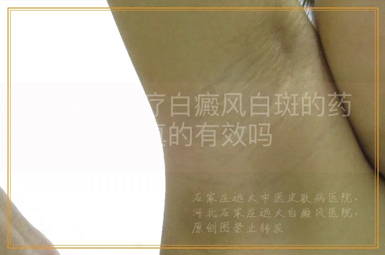 补骨脂治疗白癜风白斑的药方真的有效吗