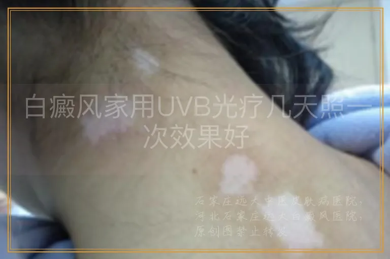白癜风家用UVB光疗几天照一次效果好