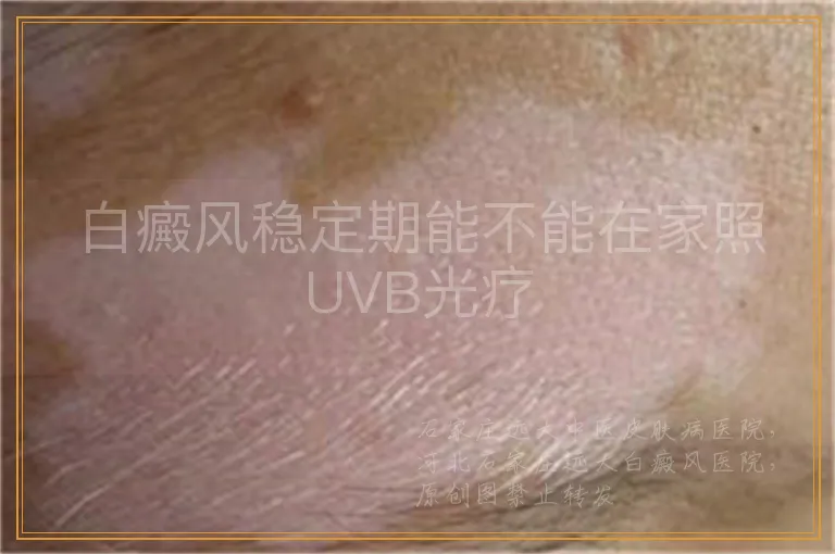 白癜风稳定期能不能在家照UVB光疗
