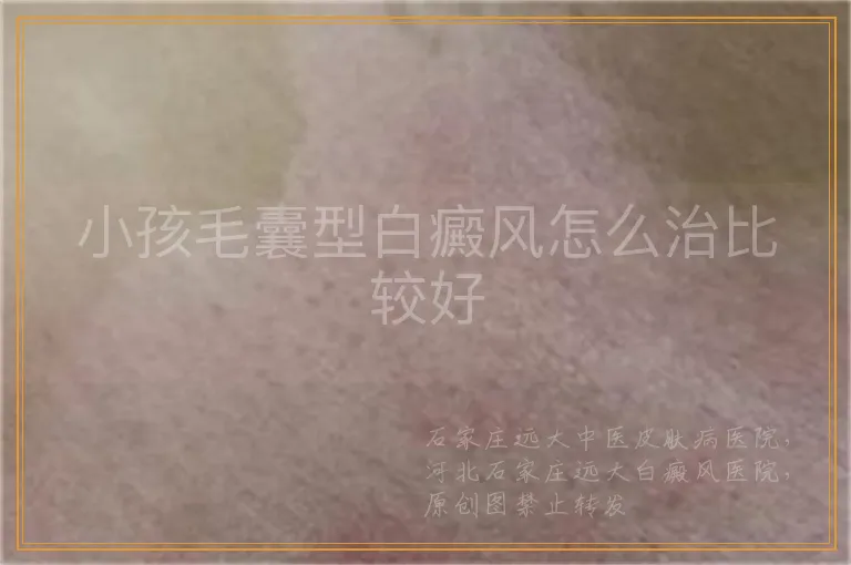 小孩毛囊型白癜风怎么治比较好