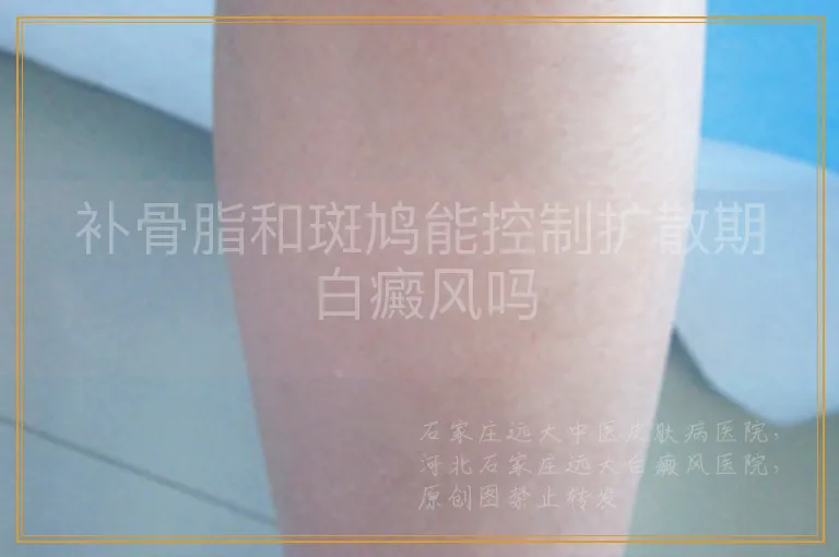 补骨脂和斑鸠能控制扩散期白癜风吗