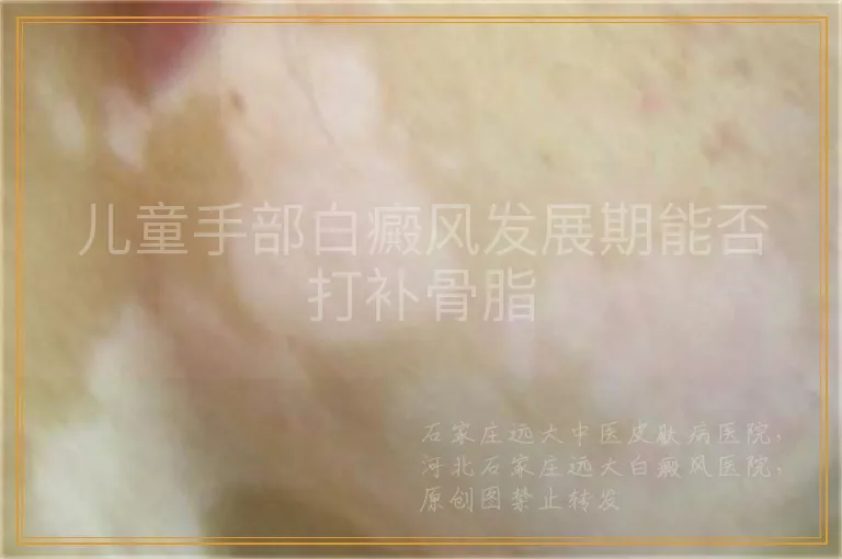 儿童手部白癜风发展期能否打补骨脂