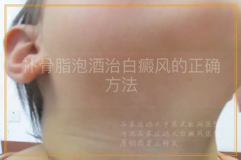 补骨脂泡酒治白癜风的正确方法