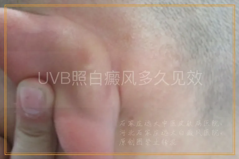 UVB照白癜风多久见效
