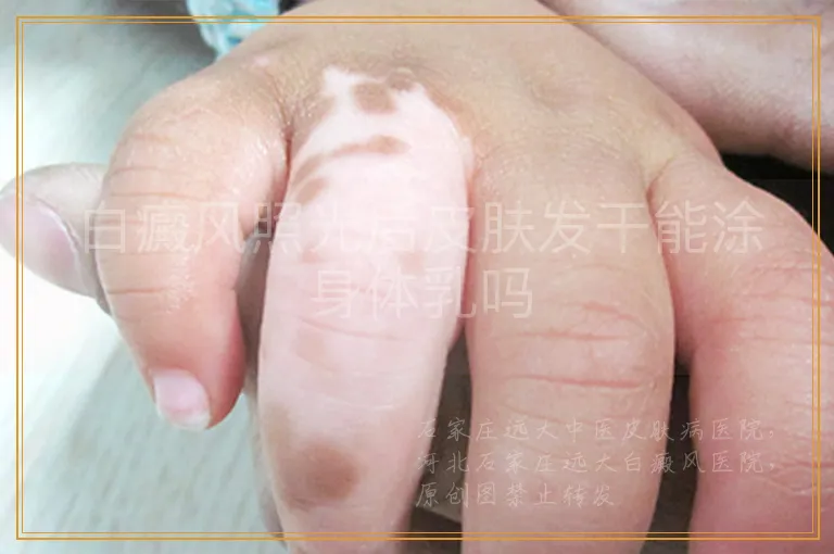 白癜风照光后皮肤发干能涂身体乳吗