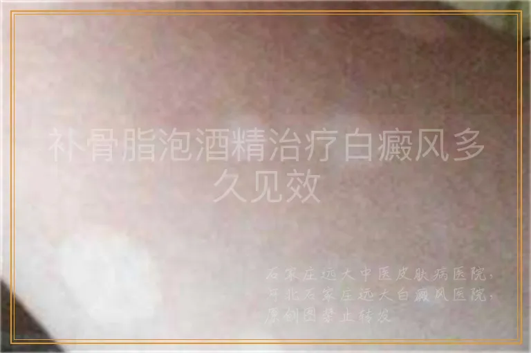 补骨脂泡酒精治疗白癜风多久见效