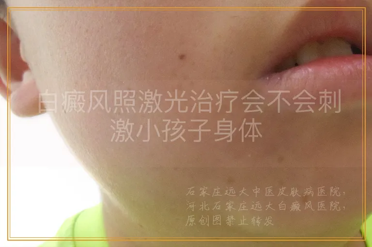 白癜风照激光治疗会不会刺激小孩子身体