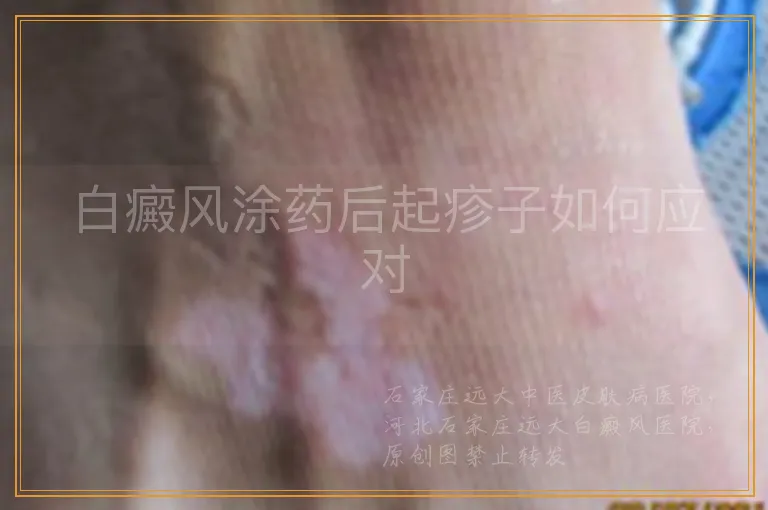 白癜风涂药后起疹子如何应对
