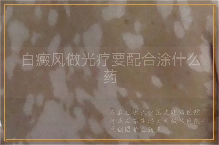 白癜风做光疗要配合涂什么药