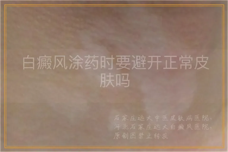 白癜风涂药时要避开正常皮肤吗