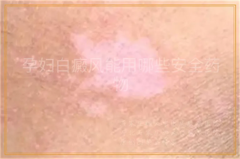 孕妇白癜风能用哪些安全药物