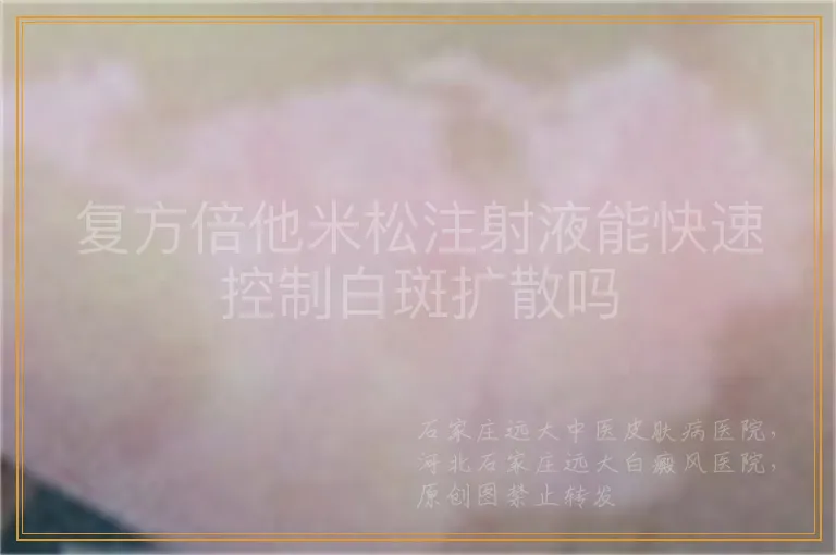 复方倍他米松注射液能快速控制白斑扩散吗