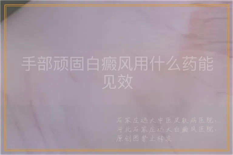 手部顽固白癜风用什么药能见效