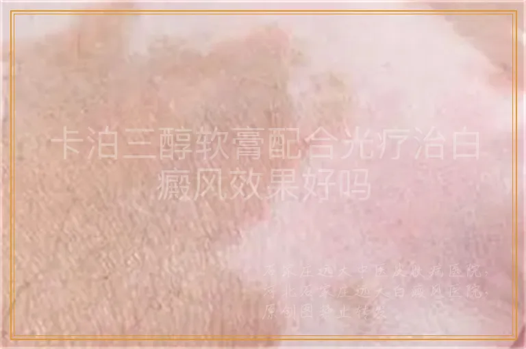 卡泊三醇软膏配合光疗治白癜风效果好吗