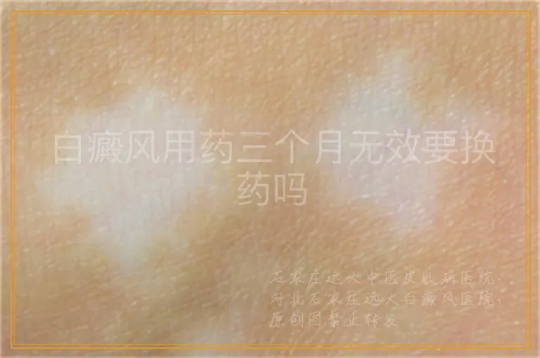 白癜风用药三个月无效要换药吗