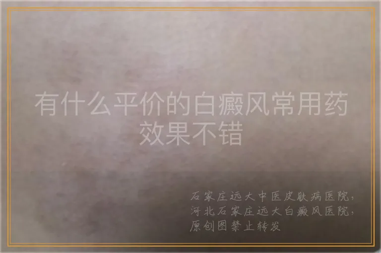 有什么平价的白癜风常用药效果不错