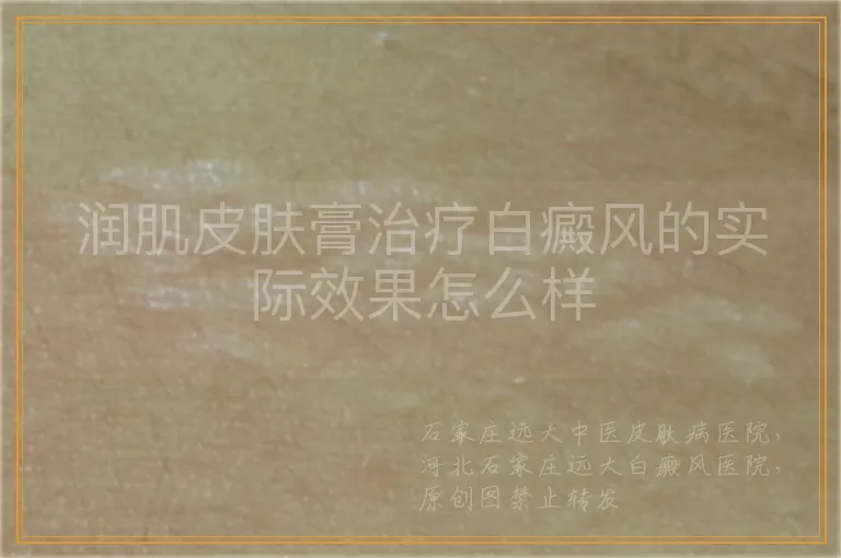 润肌皮肤膏治疗白癜风的实际效果怎么样