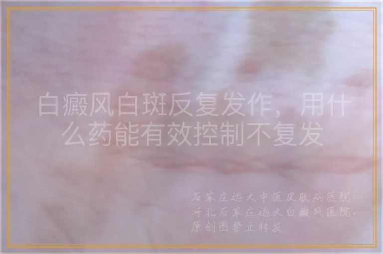 白癜风白斑反复发作，用什么药能有效控制不复发