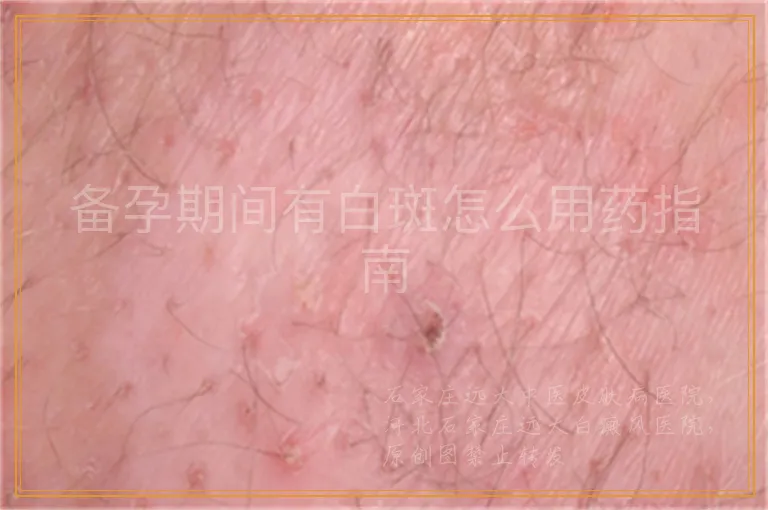 备孕期间有白斑怎么用药指南