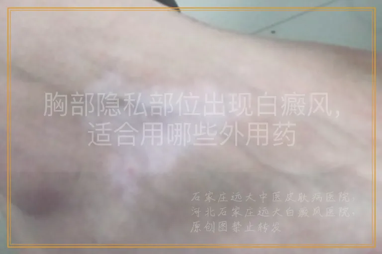 胸部隐私部位出现白癜风，适合用哪些外用药