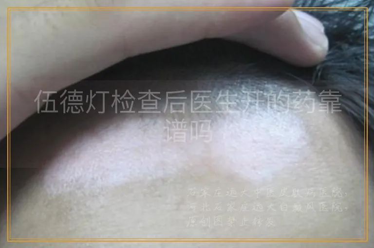 伍德灯检查后医生开的药靠谱吗