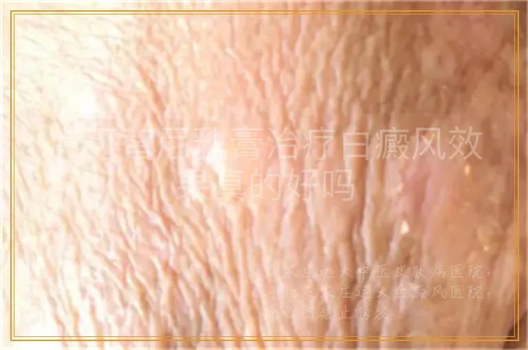 卢可替尼乳膏治疗白癜风效果真的好吗