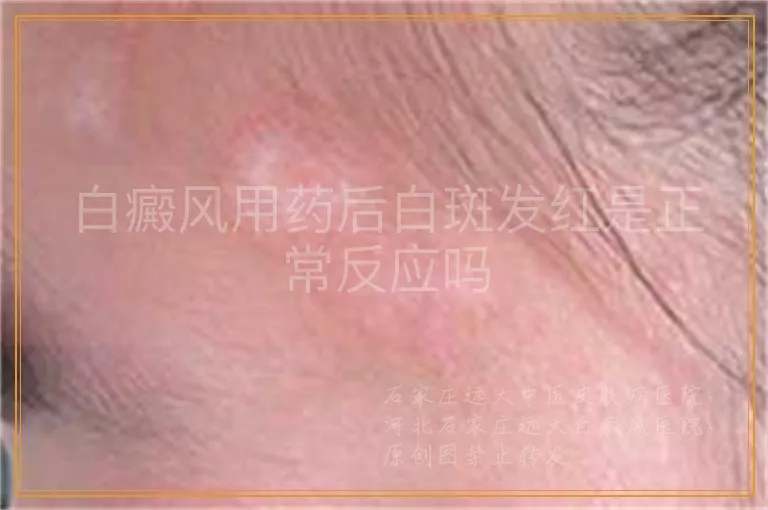 白癜风用药后白斑发红是正常反应吗
