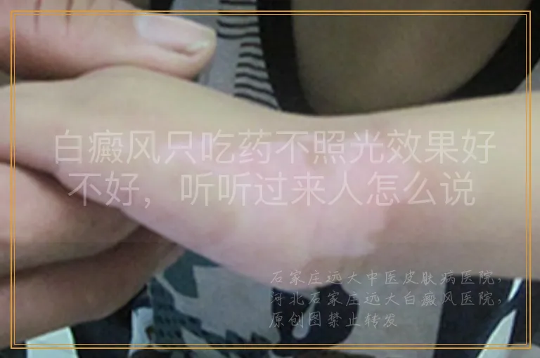 白癜风只吃药不照光效果好不好，听听过来人怎么说