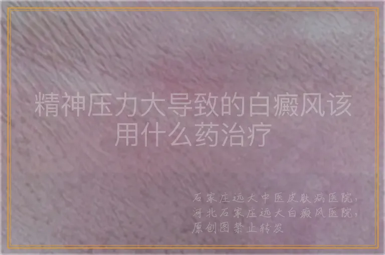 精神压力大导致的白癜风该用什么药治疗