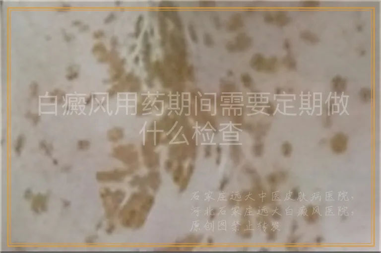 白癜风用药期间需要定期做什么检查