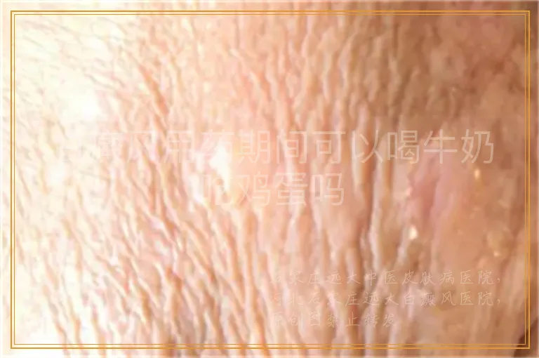 白癜风用药期间可以喝牛奶吃鸡蛋吗