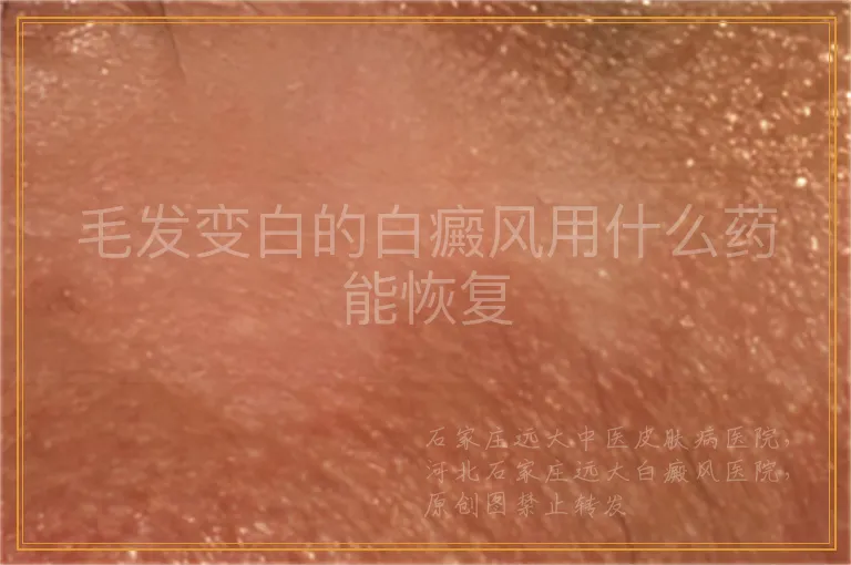 毛发变白的白癜风用什么药能恢复