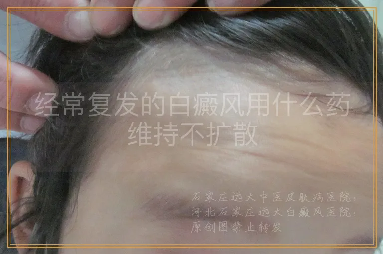 经常复发的白癜风用什么药维持不扩散