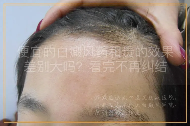便宜的白癜风药和贵的效果差别大吗？看完不再纠结
