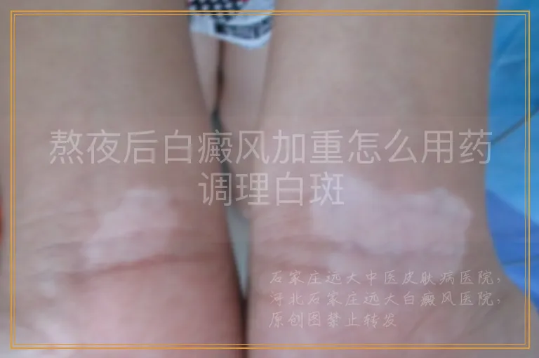 熬夜后白癜风加重怎么用药调理白斑