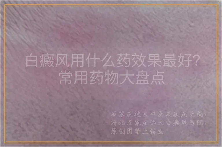 白癜风用什么药效果最好？常用药物大盘点