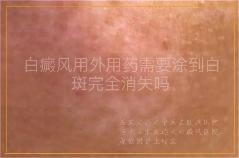 白癜风用外用药需要涂到白斑完全消失吗