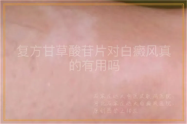 复方甘草酸苷片对白癜风真的有用吗