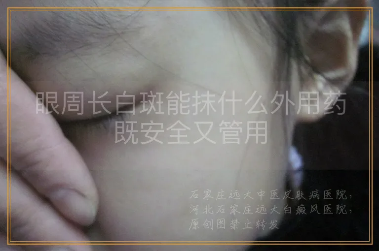 眼周长白斑能抹什么外用药既安全又管用