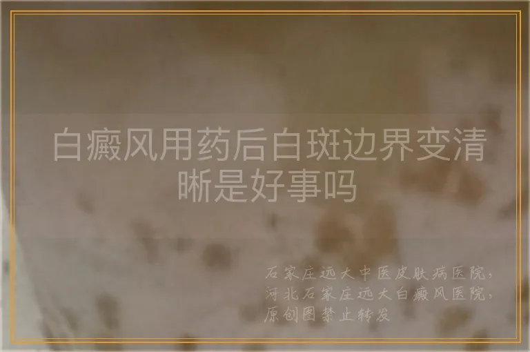 白癜风用药后白斑边界变清晰是好事吗
